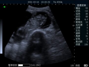 bu202 ultrasound scanner with rectal convex array found 3 months fetus_tn