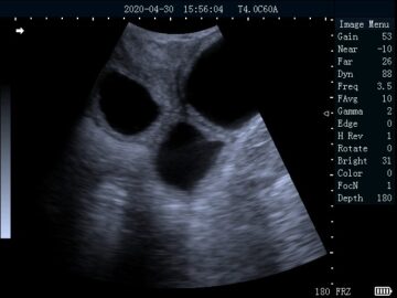 bu202 ultrasound scanner with rectal convex array found cyst uterine_tn